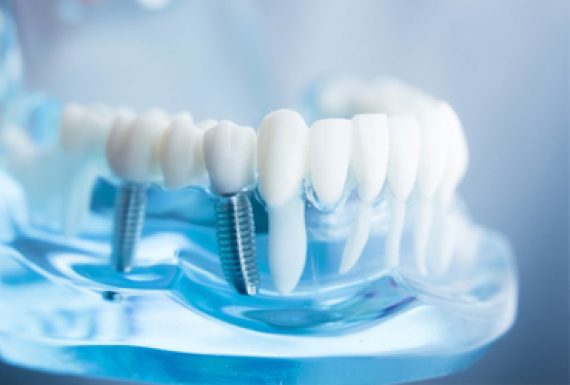 Dental Implants